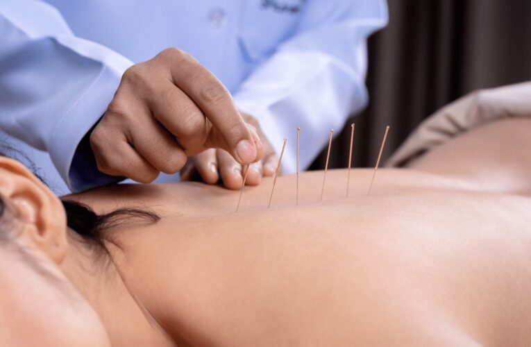 Akupunktur: En Traditionel Helbredelsesmetode